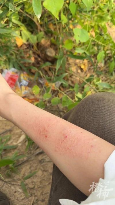 女子上山露营，3米高树上突然砸下带刺的“球”！手臂扎了20多根刺，连跑三家医院都处理不了，网友提供“土方法”，有用吗？