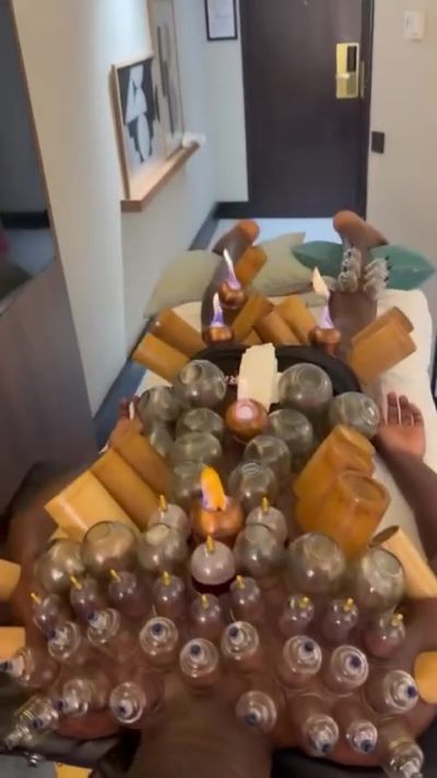 神秘力量！30岁奥纳纳恢复治疗，从肩部到小腿密密麻麻拔满罐！