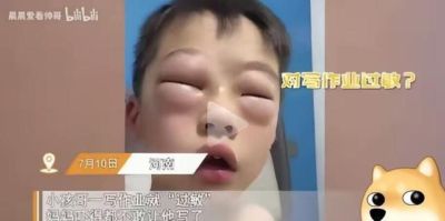 河南男孩一写作业眼睛就肿成乒乓球，停笔立马消肿，全网家长笑疯：这是顶级苦肉计！